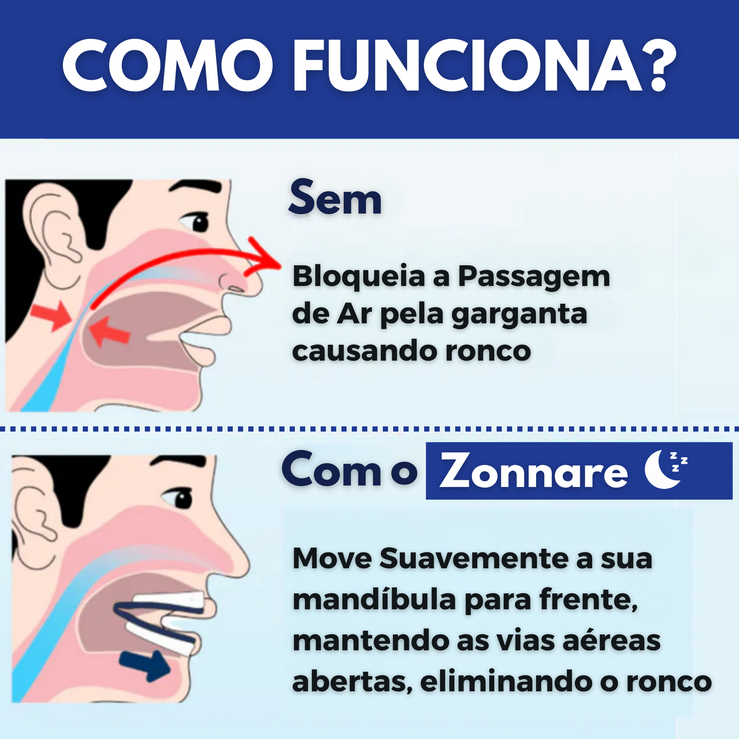 Protetor Bucal Anti-Ronco Zonnare